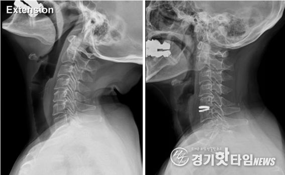 인공 디스크 삽입 전 후